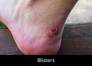 pic-blisters General Podiatry