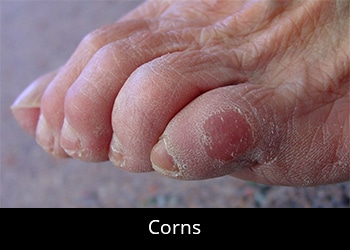 pic-corns Nail & Skin