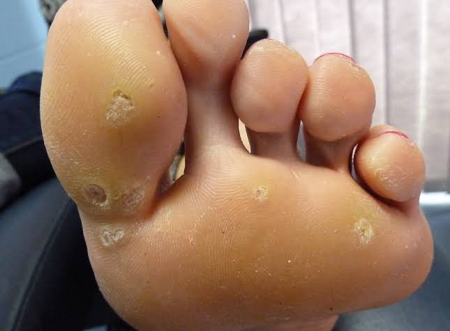 wart on foot reflexology pastile de papilom pe corp