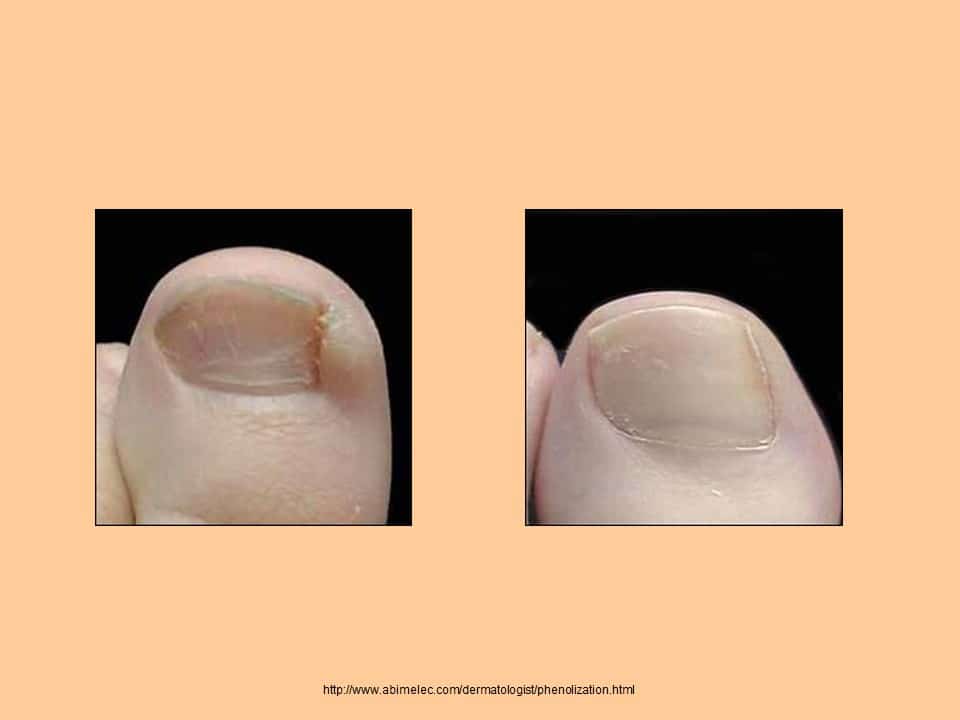 Take Control of Fungal Nail Treatment and Prevention for Healthy Nails -  Sbrma