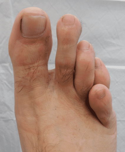 Pediatric Hammertoes (Curly Toes) Causes & Treatments
