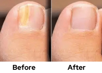 BEST Fungal Nail Treatments - YouTube