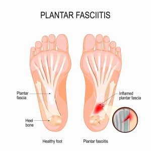 Treatment for Arthritic Big Toe Joints (Hallux Rigidus) - Perth Foot Centre