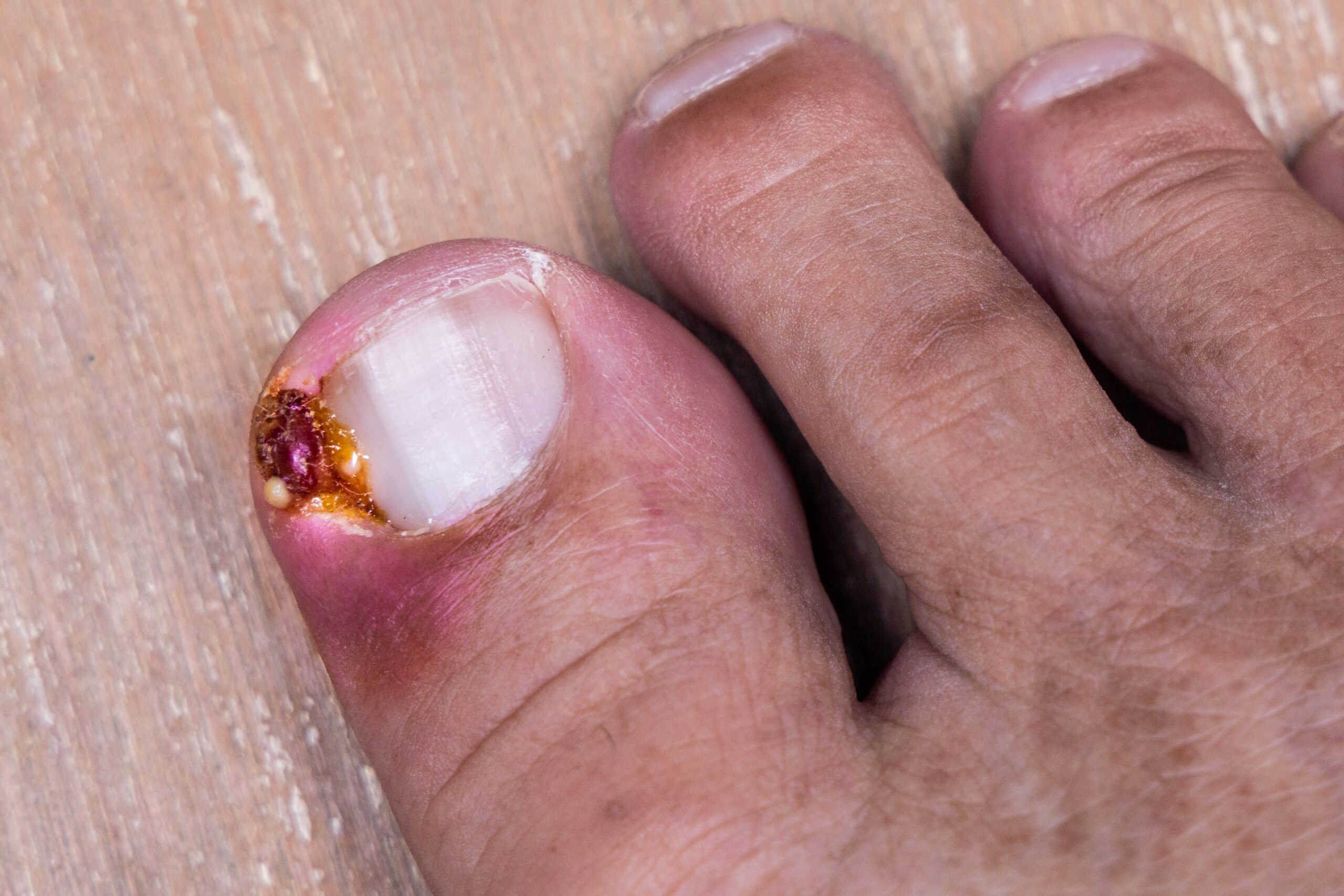 Treat Ingrown Toenails