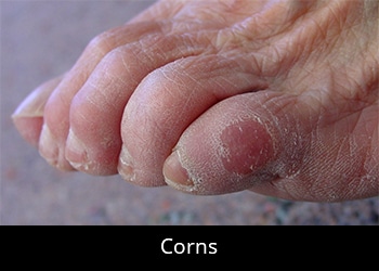 foot focus podiatry corns