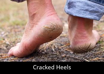 pic-cracked-heels-300x214 Cracked Heels