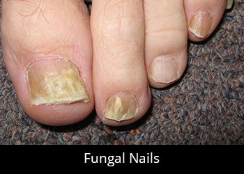 foot focus podiatry fungal-nails