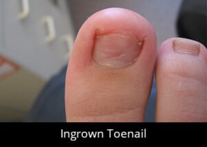 ingrown-toenail foot focus podiatry