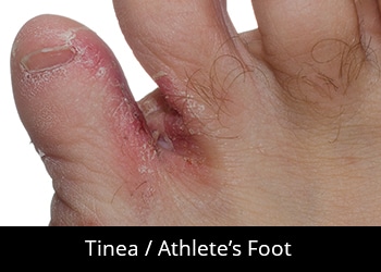 pic-tinea-athletes-foot