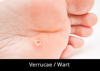 pic-verrucae-wart