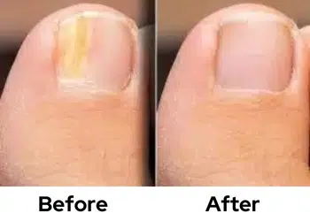 Fungal Nail Treatment in Perth