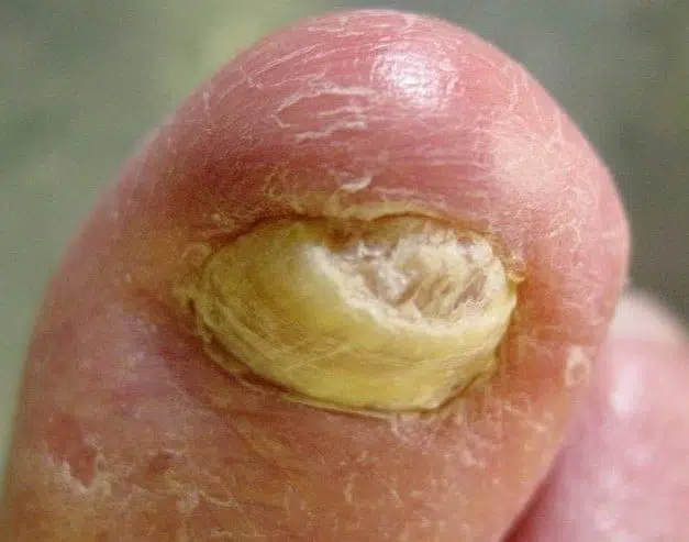 Fungal nail