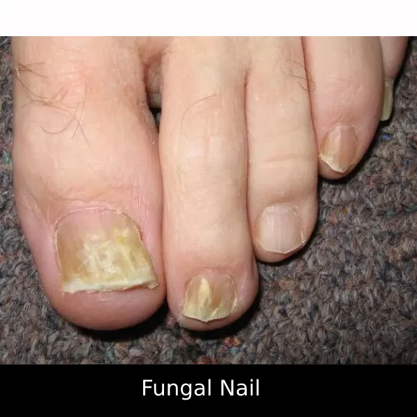 Fungal_Nail-1