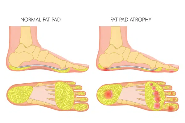 Heel Pad Inflammation