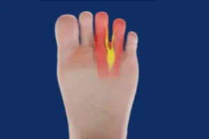 Mortons Neuroma