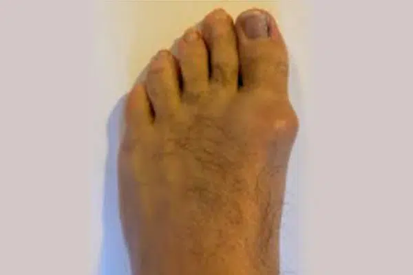 Stiff Big Toe / Hallux Limitus