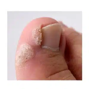 Wart-on-big-toe