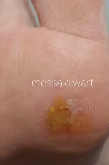 Wart-prior-to-needling