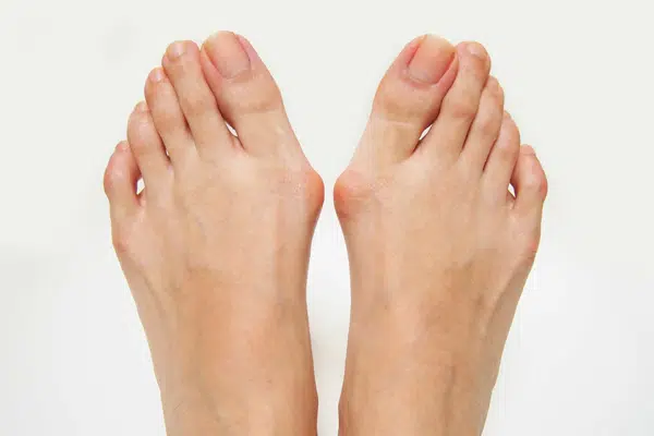 Bunion / Hallux Valgus