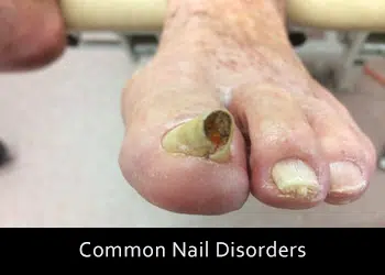 nail-disorders.jpg