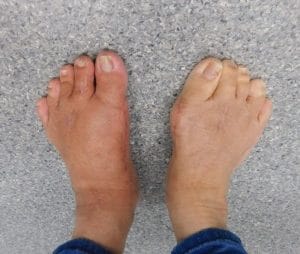 Bunion-surgery-3-e1582526677571-300x254 Bunion / Hallux Valgus