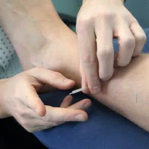 DSC01292_topfootneedle-300x200 Dry Needling Trigger Point Therapy