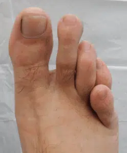 hammer toe surgery perth