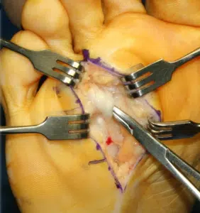 Neurectomy-incision-on-the-bottom-op