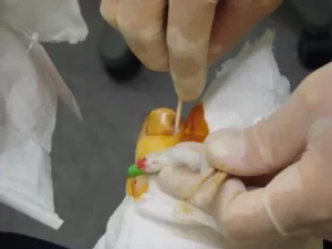 toenail surgery