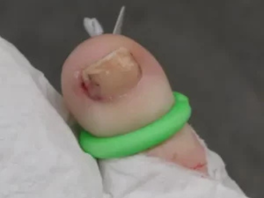 toenail surgery