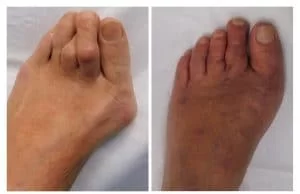 Bunion-surgery