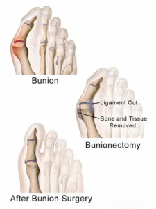 bunion surgery