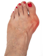 Large bunion Large bunion