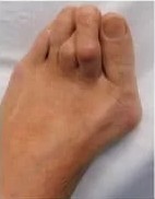 severe bunion