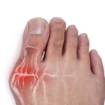 Can a Podiatrist Get Rid of Bunions