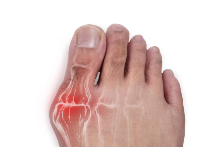 Can a Podiatrist Get Rid of Bunions