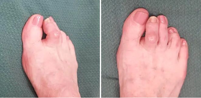 Hammer Toes Treatment Perth