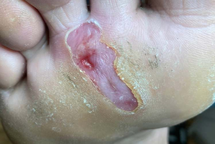 RESIZED diabetes blister turned to ulcer