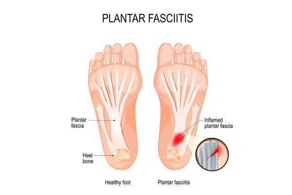 Plantar-Fasciitis-Heel-Pain