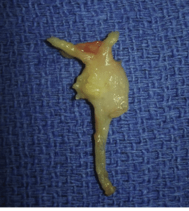 Excised Morton’s Neuroma