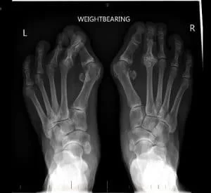 bunion srgery before example
