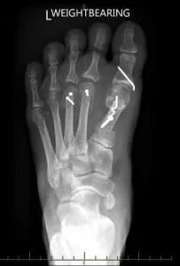 buynion surgery after 2
